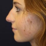 Rhinoplasty Before & After Patient #3735