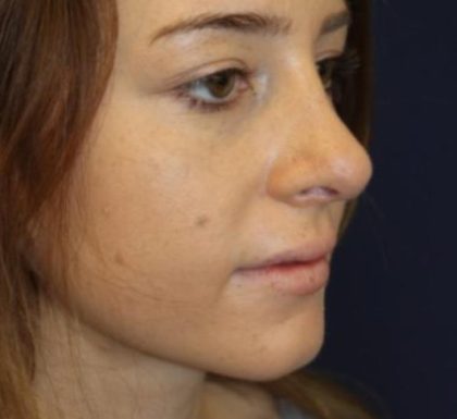 Rhinoplasty Before & After Patient #3735