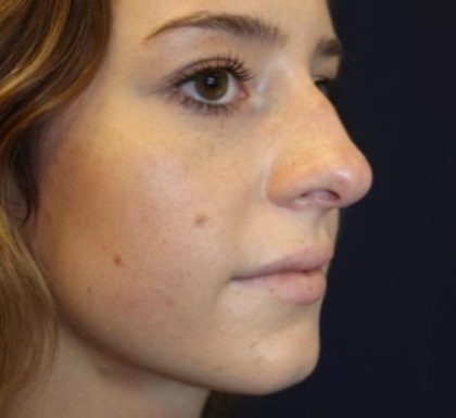 Rhinoplasty Before & After Patient #3735