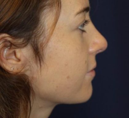 Rhinoplasty Before & After Patient #3735