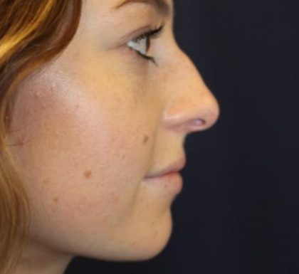 Rhinoplasty Before & After Patient #3735