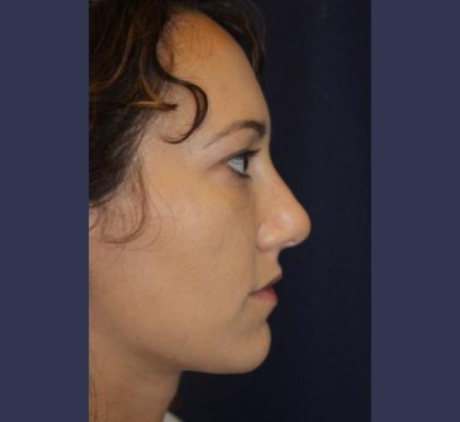 Rhinoplasty Before & After Patient #3799