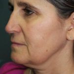 Rhinoplasty Before & After Patient #3848