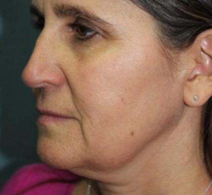 Rhinoplasty Before & After Patient #3848