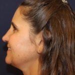 Rhinoplasty Before & After Patient #3848