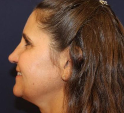 Rhinoplasty Before & After Patient #3848