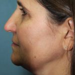 Rhinoplasty Before & After Patient #3848