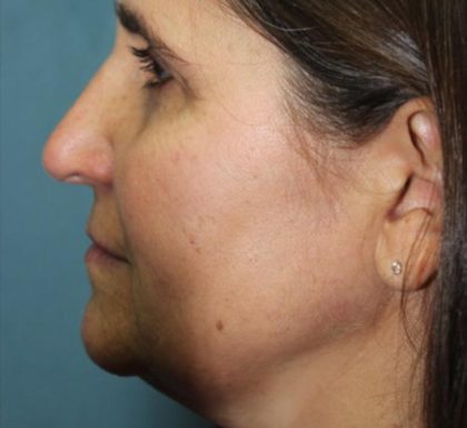 Rhinoplasty Before & After Patient #3848