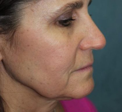 Rhinoplasty Before & After Patient #3848