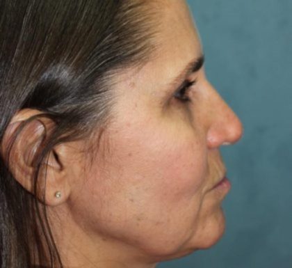 Rhinoplasty Before & After Patient #3848