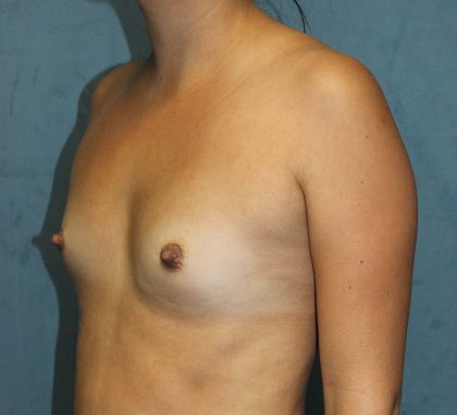 Breast Augmentation Before & After Patient #4350
