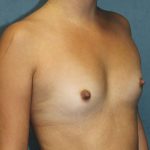 Breast Augmentation Before & After Patient #4350