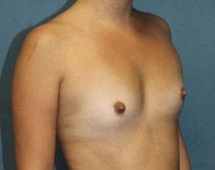 Breast Augmentation Before & After Patient #4350