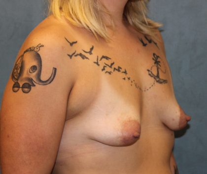 Breast Augmentation Before & After Patient #5157