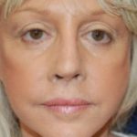 Facelift Before & After Patient #3109