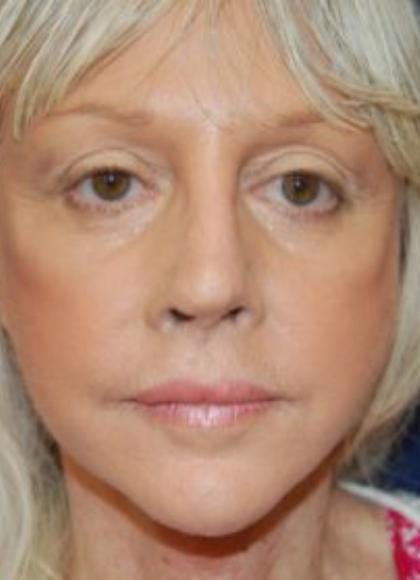 Facelift Before & After Patient #3109