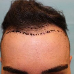 Hair Restoration Before & After Patient #5660