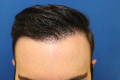 Hair Restoration Before & After Patient #5660