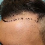 Hair Restoration Before & After Patient #5660