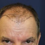 Hair Restoration Before & After Patient #5661