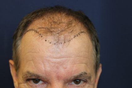 Hair Restoration Before & After Patient #5661