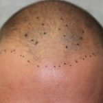 Hair Restoration Before & After Patient #5888