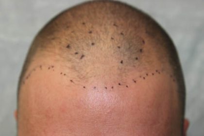Hair Restoration Before & After Patient #5888