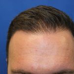Hair Restoration Before & After Patient #5888
