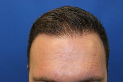 Hair Restoration Before & After Patient #5888