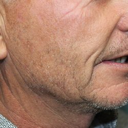 Hair Restoration Before & After Patient #5874