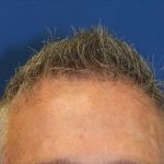 Hair Restoration Before & After Patient #5809