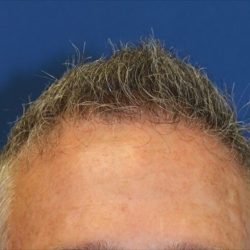 Hair Restoration Before & After Patient #5809