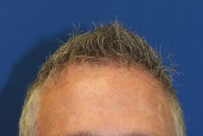 Hair Restoration Before & After Patient #5809