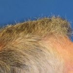 Hair Restoration Before & After Patient #5809