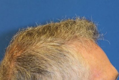 Hair Restoration Before & After Patient #5809