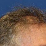 Hair Restoration Before & After Patient #5809