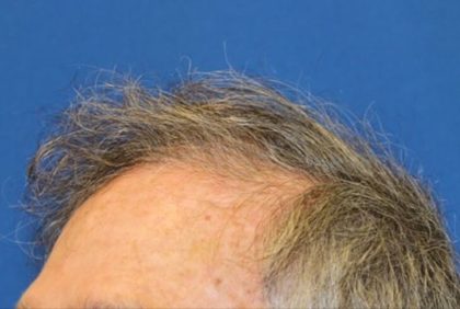 Hair Restoration Before & After Patient #5809
