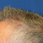 Hair Restoration Before & After Patient #5809