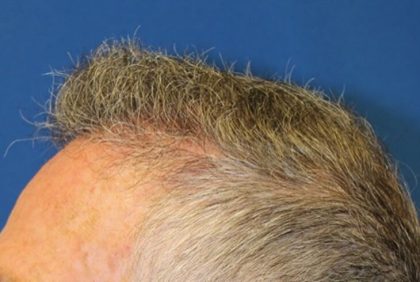 Hair Restoration Before & After Patient #5809