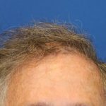 Hair Restoration Before & After Patient #5809