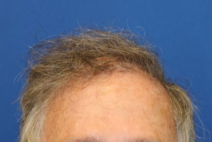 Hair Restoration Before & After Patient #5809