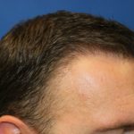 Hair Restoration Before & After Patient #5816