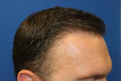 Hair Restoration Before & After Patient #5816