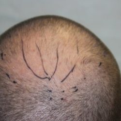 Hair Restoration Before & After Patient #5816
