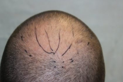 Hair Restoration Before & After Patient #5816