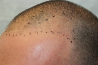 Hair Restoration Before & After Patient #5816