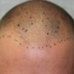 Hair Restoration Before & After Patient #5816