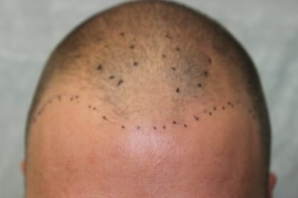 Hair Restoration Before & After Patient #5816