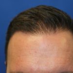 Hair Restoration Before & After Patient #5816