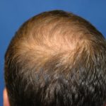 Hair Restoration Before & After Patient #5816